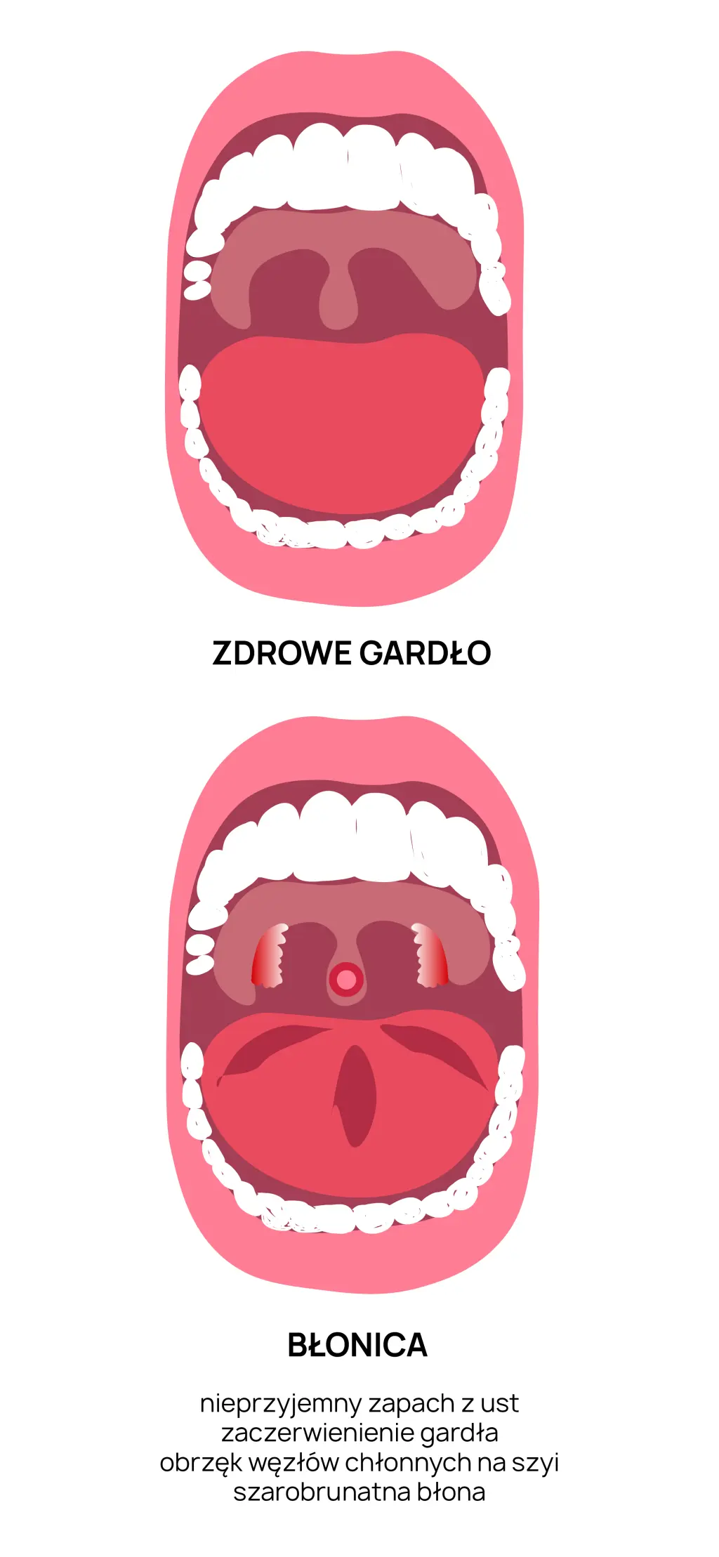 Objawy błonicy