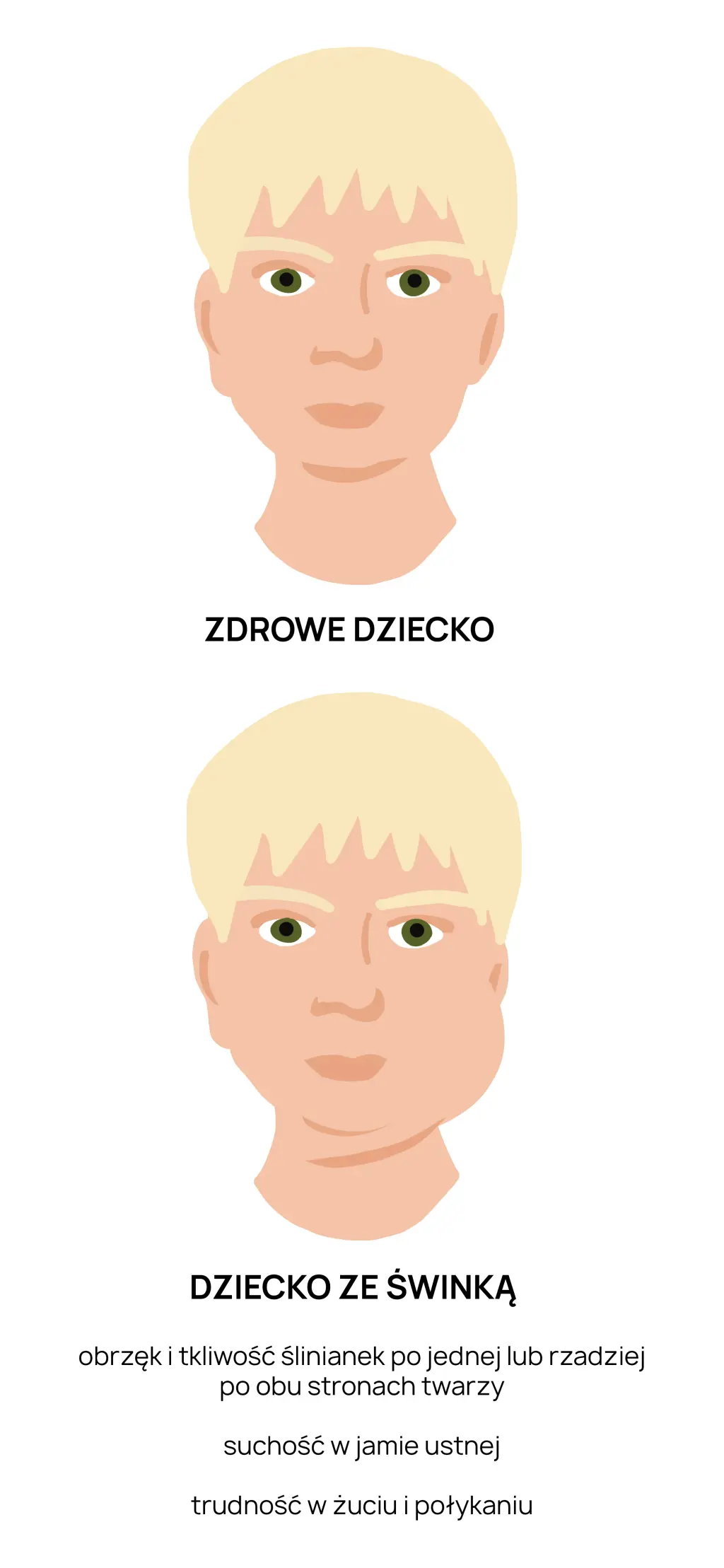 Objawy świnki