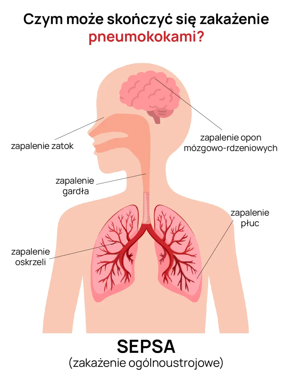 Objawy i powikłania choroby pneumokokowej